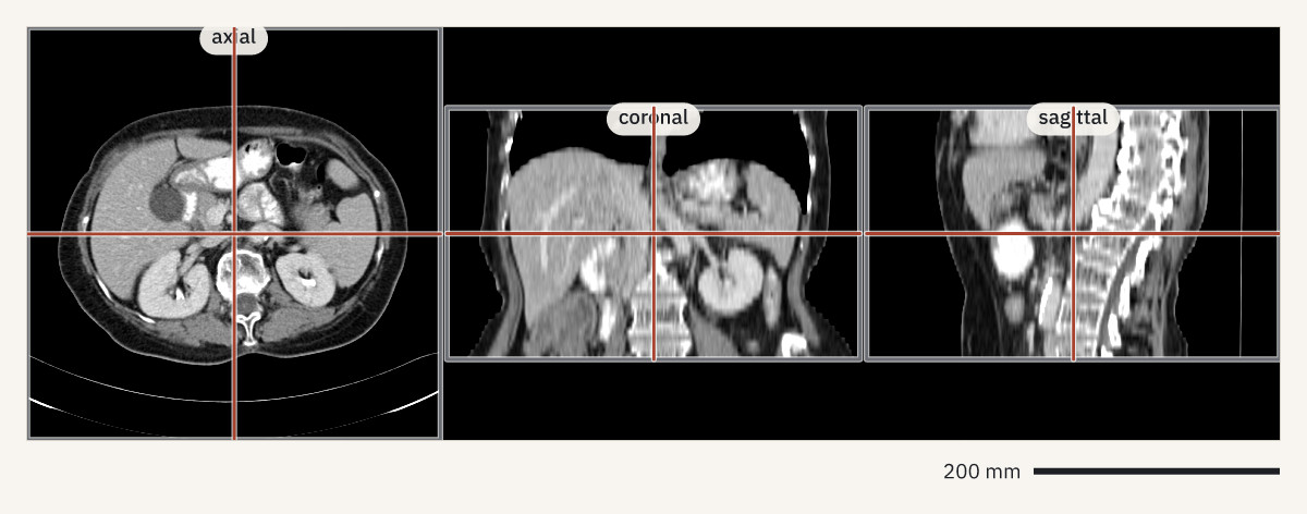 Axial, coronal and sagittal cuts of an abdominal CT with lines where the planes cross and a 200 mm scale bar